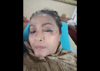 Terkena Musibah Korban Tabrak Lari, Wajah Machica Mochtar Lebam