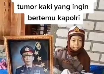 Kapolri Merespons Permintaan Sinta Aulia, Anak Penderita Tumor Kaki